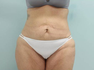 Abdominoplasty