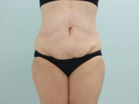 Abdominoplasty