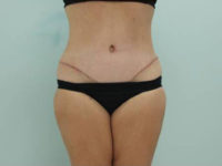 Abdominoplasty