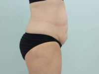 Abdominoplasty