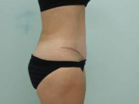 Abdominoplasty