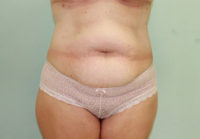 Abdominoplasty