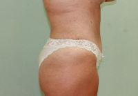 Abdominoplasty