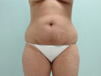 Abdominoplasty