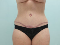 Abdominoplasty