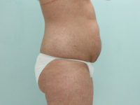 Abdominoplasty