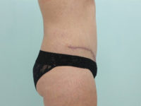 Abdominoplasty