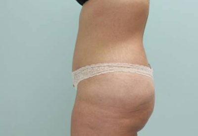 Abdominoplasty