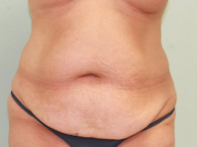 Abdominoplasty