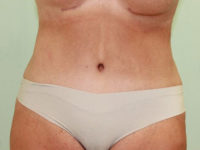 Abdominoplasty