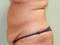 Abdominoplasty