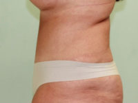 Abdominoplasty