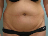 Abdominoplasty