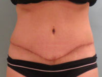 Abdominoplasty