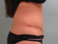 Abdominoplasty