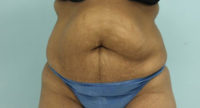 Abdominoplasty