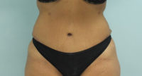 Abdominoplasty