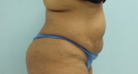 Abdominoplasty