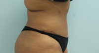 Abdominoplasty