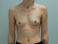 Breast Augmentation