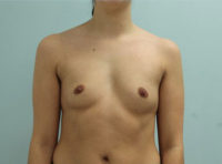 Breast Augmentation