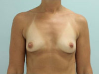 Breast Augmentation