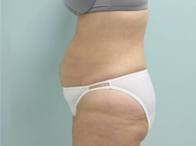 Tummy Tuck Athens, GA