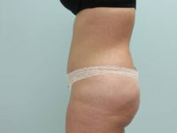 Abdominoplasty