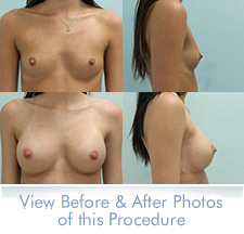 Breast Augmentation Results Athens