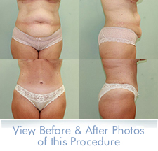 Tummy Tuck, Athens GA