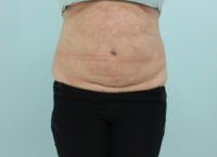 Abdominoplasty