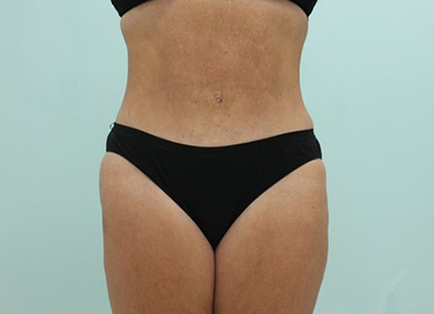 Abdominoplasty