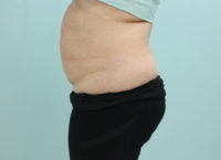 Abdominoplasty