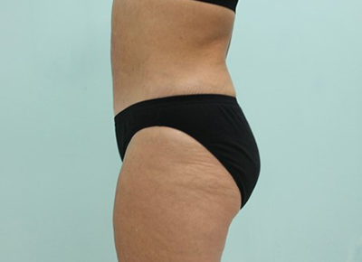 Abdominoplasty