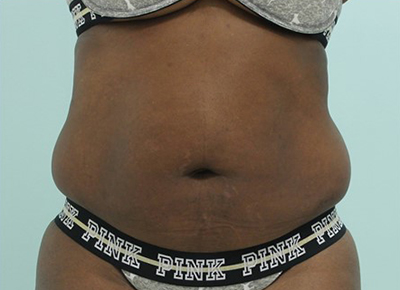 Abdominoplasty