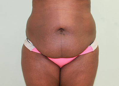 Abdominoplasty