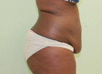 Abdominoplasty