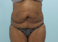 Abdominoplasty