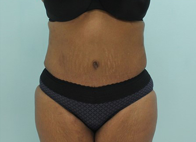 Abdominoplasty