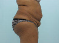 Abdominoplasty