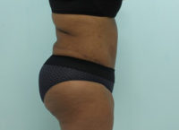 Abdominoplasty