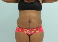 Abdominoplasty