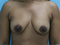 Breast Augmentation