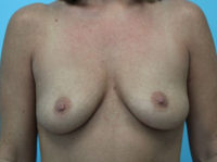 Breast Augmentation