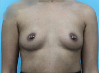 Breast Augmentation