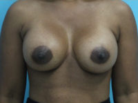 Breast Augmentation