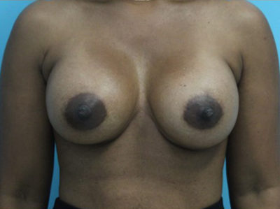 Breast Augmentation