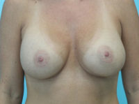 Breast Augmentation