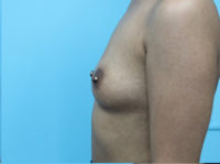 Breast Augmentation