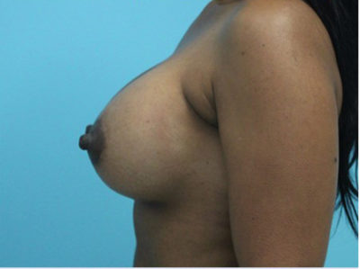 Breast Augmentation